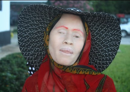 Love in a time of fear: Albino women’s stories from Tanzania